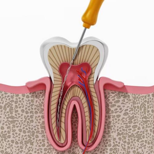 أصول کلی آماده سازی دندان در درمان ریشه